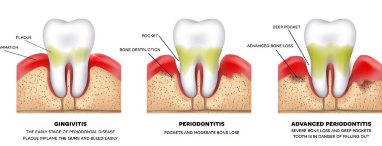 치아결손 시 암 위험 증가? 구강내 염증의 엄청난 나비효과 관련 이미지 2