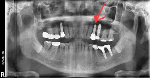 국산임플란트를 선택한 이유, 치료사례 공개합니다 관련 이미지 11