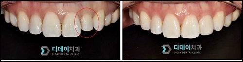 왜소치라미네이트, 치과 의사가 설명해준다면? 관련 이미지 3