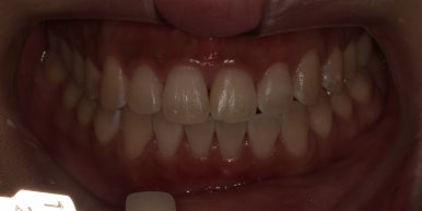 치과미백비용? 효과? A 부터 Z까지 탈탈 털어 알려드립니다. 관련 이미지 11