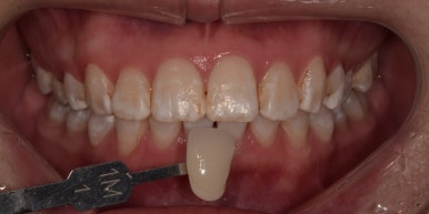 [진심인터뷰] &ldquo;한국까지 와서 원데이치아미백 했어요&rdquo; - 일본에서 온 두 친구 이야기 관련 이미지 5