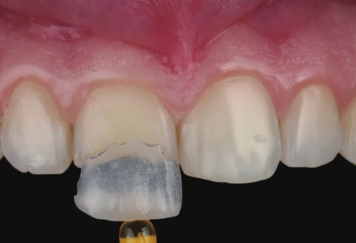 아랫니라미네이트, 잘하는 치과 찾는 2가지 기준 의사 작성 관련 이미지 8