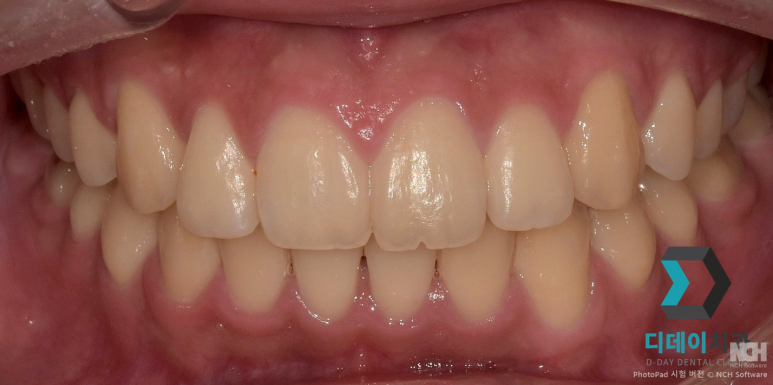치아미백 라미네이트 잘하는 곳 찾는 2가지 기준 관련 이미지 6
