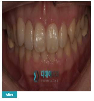 웨딩 전 라미네이트, 하시고도 후회하고 싶으시면? 관련 이미지 3