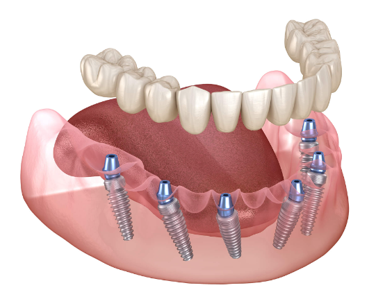 40대 전체 임플란트, 아직 젊은데 치아를 전부 발치해야만 하는 걸까? 관련 이미지 8
