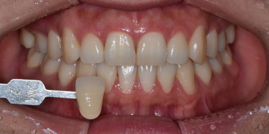 최소증상 치아미백 치과 후기,일본에서도 오는 이유? 관련 이미지 5