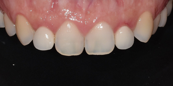 작은이빨, 왜소치? 치아 크기를 키우고 싶은 분만 <필독> 관련 이미지 2