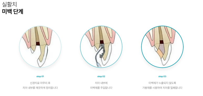 치아 검은색 치료하는 실활치미백, 방법과 비용까지 한번에 정리! 관련 이미지 5