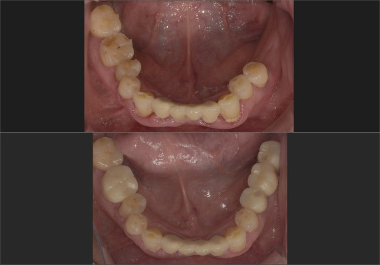 임플란트브릿지? 치아 개수대로 임플란트 심지 않아도 됩니다 관련 이미지 6