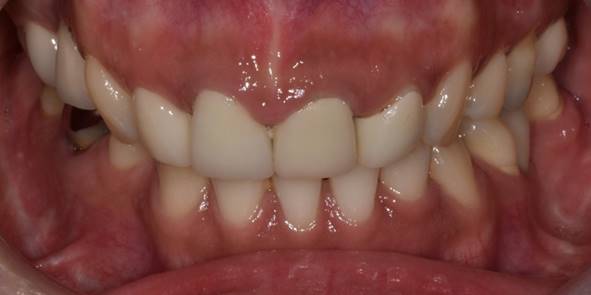 라미네이트통증, 아플까봐 걱정된다면? 확인해보세요 관련 이미지 7