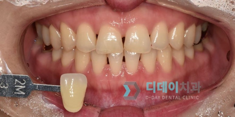 강남치아미백, 금세 또 착색되는 이유와 원데이 치료사례 관련 이미지 2