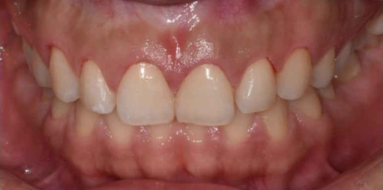 잇몸성형가격? 비용, 주의사항, 치료 후기 공개 관련 이미지 14