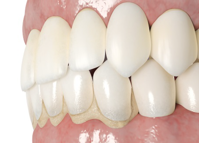 잇몸 내려앉음 시림 원인과 치료법 관련 이미지 3