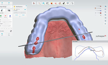 선릉 투명교정 시작 전, 반드시 확인할 체크리스트 관련 이미지 5