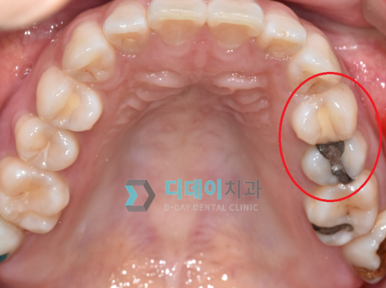충치치료기간, 치료별 내원횟수와 기간까지 총정리 관련 이미지 6