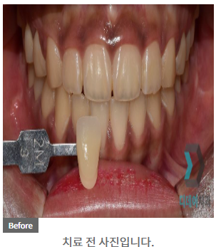 원데이 치과미백 치료? 5000건 해보고 알려드립니다. 관련 이미지 3