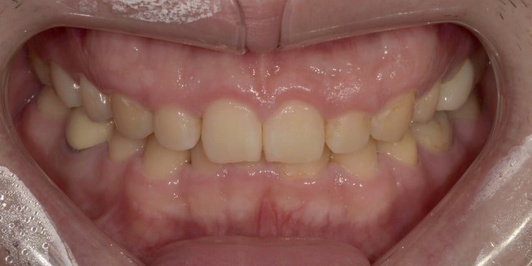 잇몸성형과 잇몸보톡스, 어떤 차이가 있는걸까요? 관련 이미지 7