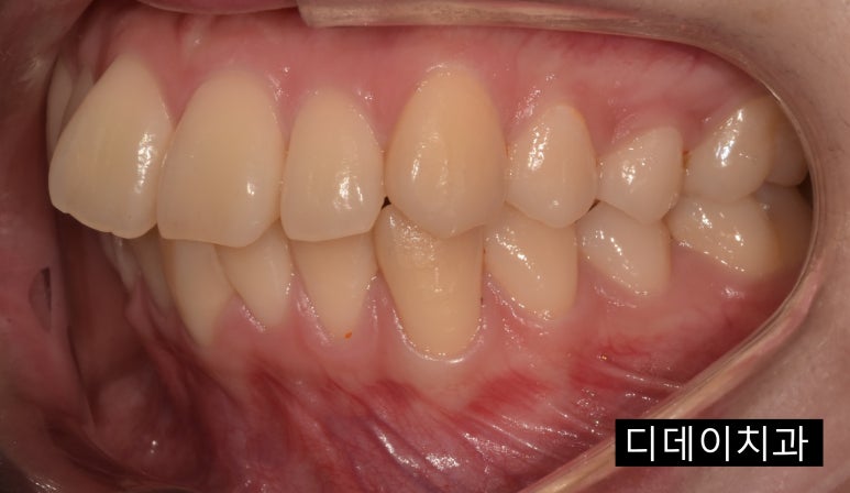 무삭제라미네이트 누구나 다 된다? 속지마세요. 관련 이미지 9