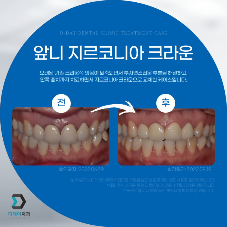 앞니크라운, 라미네이트 같이 하면 티날까? 사진으로 증명합니다. 관련 이미지 10