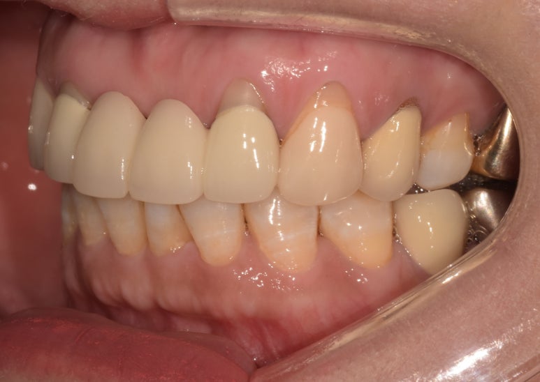 앞니브릿지, 오래된 브릿지교체하신 치료사례와 비용공개합니다. 관련 이미지 8