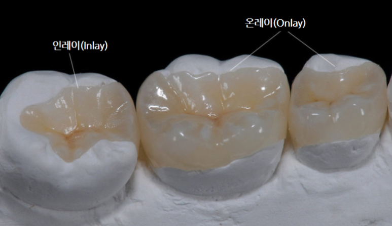 레진인레이차이, 실패하지 않으려면 이 2가지만 확인하세요 관련 이미지 6