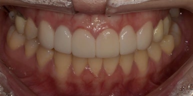 치아성형, 앞니 모양 획기적으로 바꾸는 방법이 있다? 관련 이미지 11