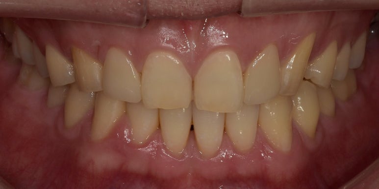 왜소치(작은치아), 꼭 치료해야할까요? 정답 알려드립니다. 관련 이미지 10