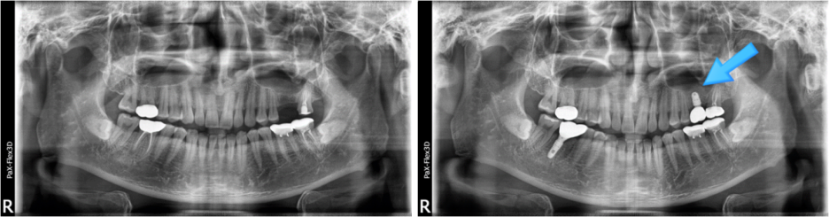 뼈이식임플란트 대상, 종류, 비용까지 전부 공개합니다. 관련 이미지 5