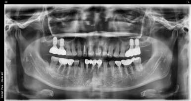 앞니임플란트, 상악동거상술임플란트 비용까지 자세히 설명드립니다. 관련 이미지 8