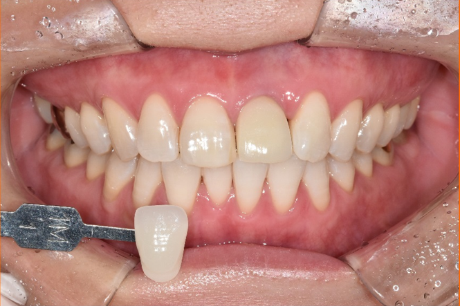 치아미백유지기간부터 종류, 주의사항까지 알려드립니다 관련 이미지 5