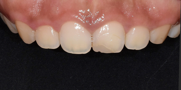 치은절제술/성형술? 잇몸이 치아를 덮고 있어 고민인 분만 관련 이미지 5