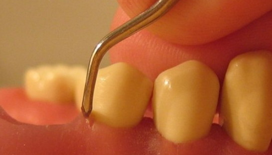 Curettage, for Gum Health image 5