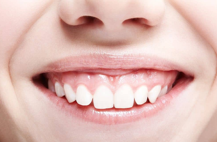 Gangnam Gum Contouring—Doesn’t It Hurt? An Honest Account of the Pain image 4