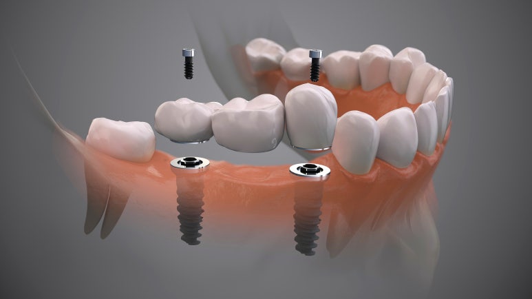 선릉역임플란트, 통증과 비용이 걱정인 분만 보세요. 관련 이미지 3