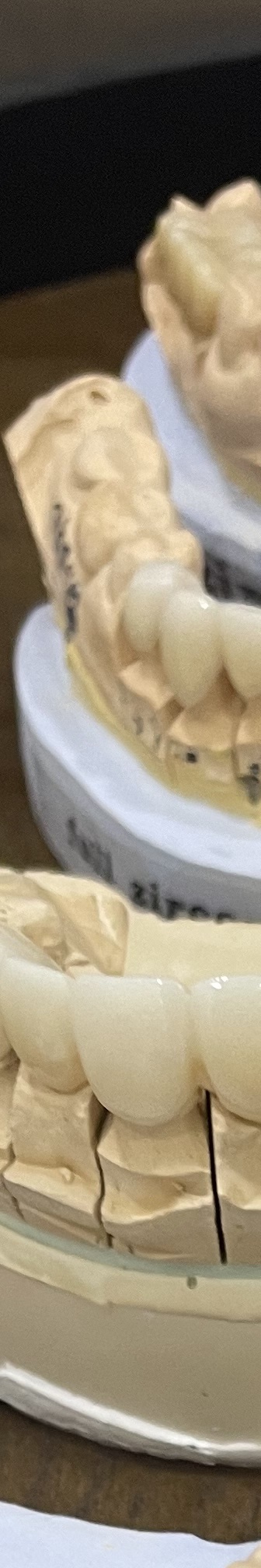 매봉역 치과, 자연치아 잃고 싶지 않다면? 관련 이미지 9