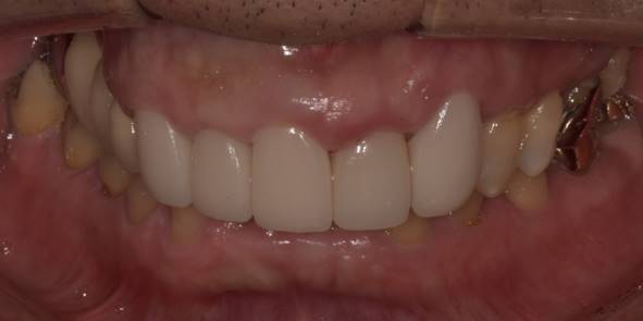 라미네이트교체, 재시술은 더 신중해야 하는 이유? 관련 이미지 6