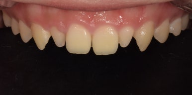 왜소치(작은치아)라미네이트? 치아 모양과 크기, 바꿀 수 있습니다. 관련 이미지 2