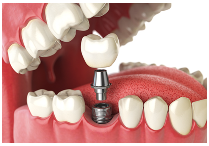 삼성역 임플란트, 이 글만 읽어보셔도 충분합니다. 관련 이미지 2