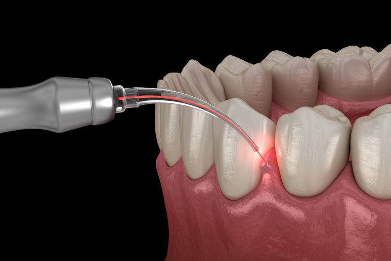 잇몸성형가격? 비용, 주의사항, 치료 후기 공개 관련 이미지 3