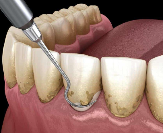 강남역스케일링, 미루면 치료비 10배 더 나옵니다 관련 이미지 3