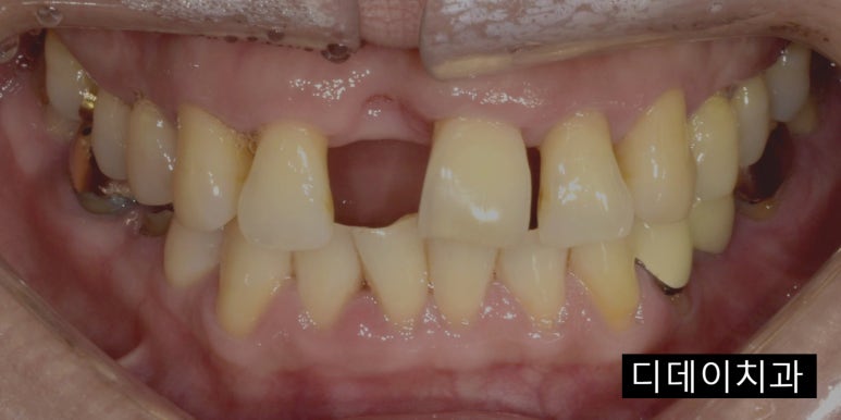 임플란트치아보험, 이렇게 하면 보장 못받을 수도 있습니다. 관련 이미지 6