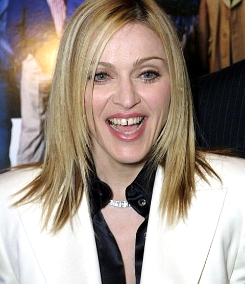 벌어진치아, 교정하지 않고 앞니틈새를 메우는 방법 관련 이미지 1