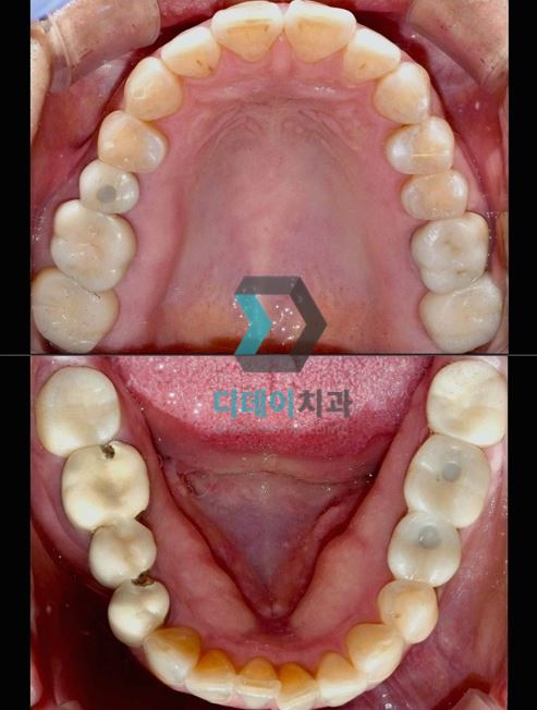 아말감교체, 꼭 해야하나요? 비용은 얼마인가요? 관련 이미지 5