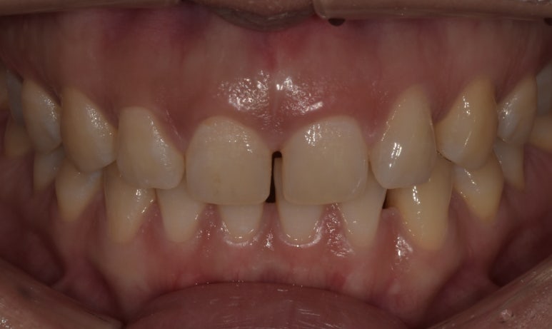 라미네이트 vs 레진 차이점 장단점 완벽 비교 관련 이미지 5