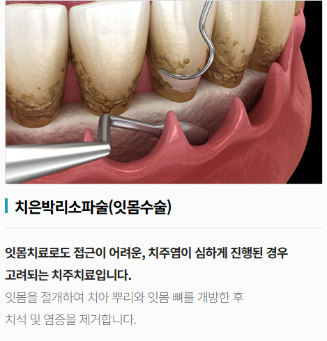 잇몸치료후통증, 며칠째라면 이것만큼은 알아야 합니다 관련 이미지 4