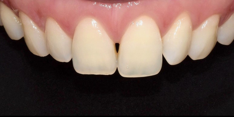 무삭제라미네이트가격, 더 비쌀 필요가 없습니다. 관련 이미지 3