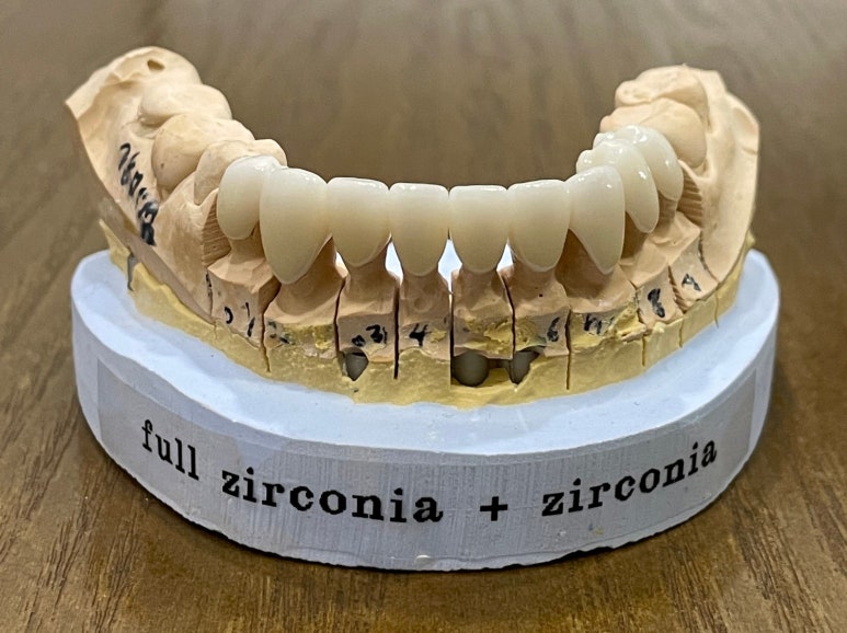 올세라믹vs지르코니아 크라운 비교분석과 비용까지 관련 이미지 4