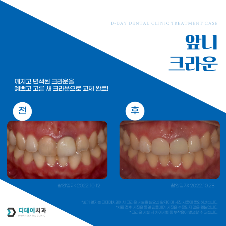 앞니크라운, 라미네이트 같이 하면 티날까? 사진으로 증명합니다. 관련 이미지 9