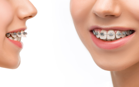 삼성역 치과 투명교정, 일반교정과 뭐가 다른지 정리해드립니다 관련 이미지 3