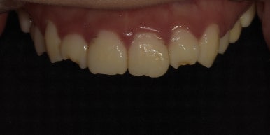 교정없이 라미네이트로 치아배열 개선? 앞니 12개 케이스 공개 관련 이미지 7